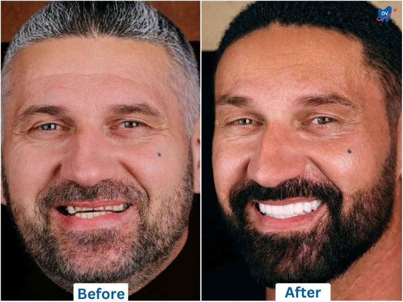 dental implants, before and after, Ankara, Turkey