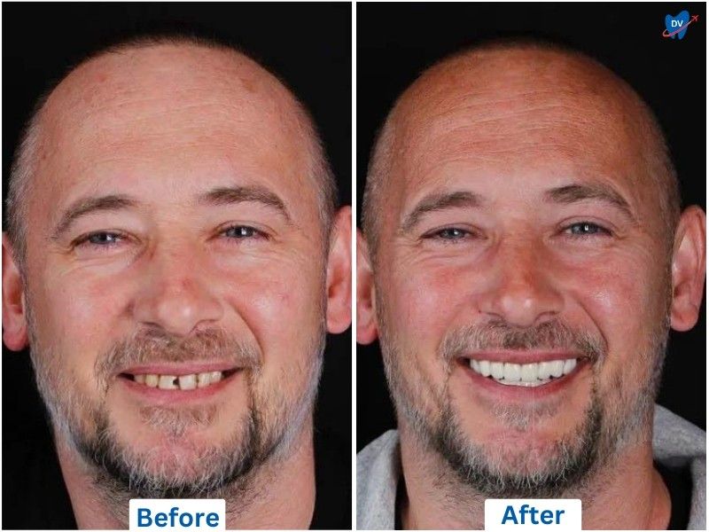 Dental implants and crowns, before and after, Ankara, Turkey