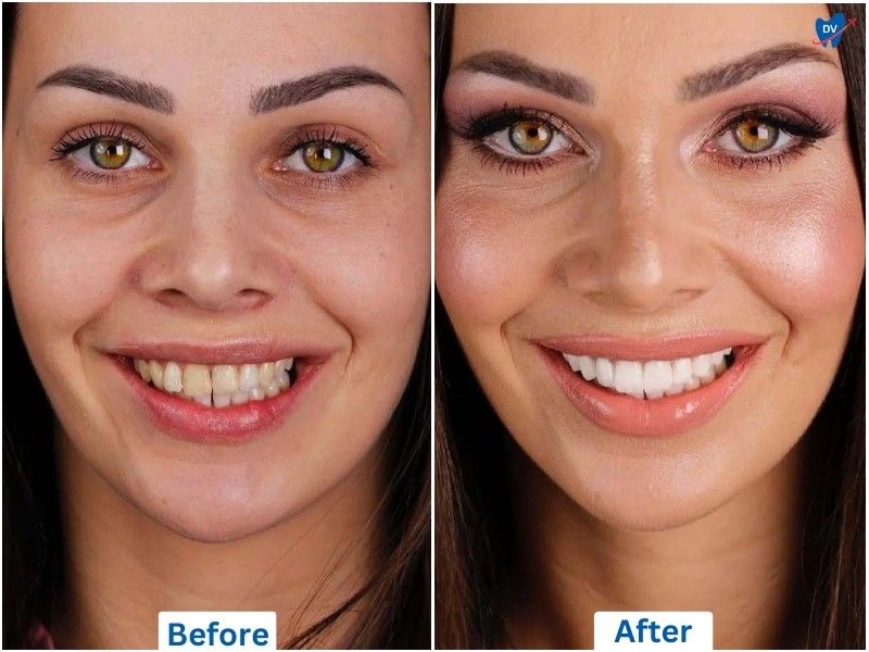 Porcelain veneers, before and after, Ankara, Turkey
