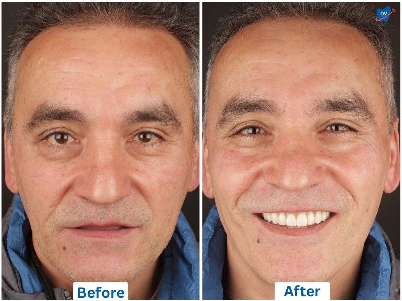 full mouth dental implants, before and after, Istanbul, Turkey