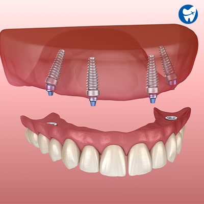 All on 4 dental implants Split Croatia