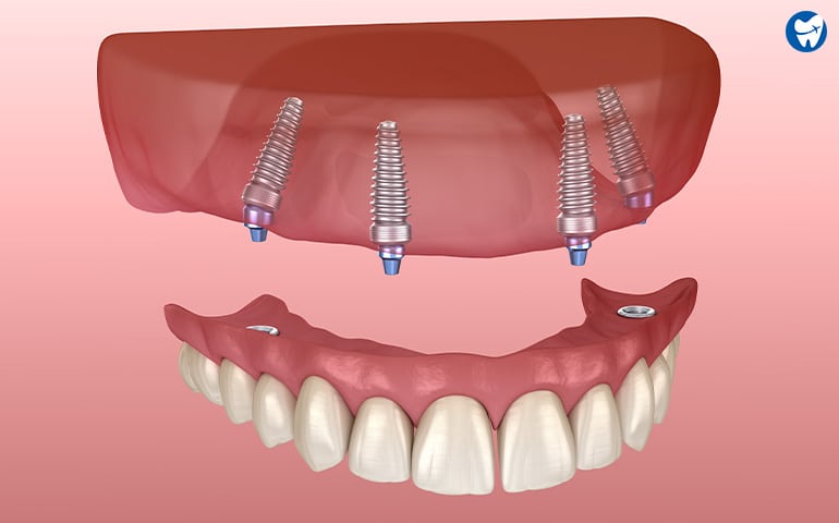 Dental Implants in Trogir, Croatia