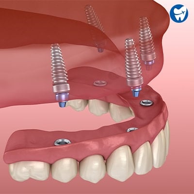 All on 4 dental implants