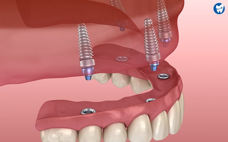 Implant-Supported Dentures | Dentures in Thailand