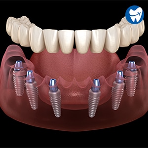 All on 6 Dental Implant 