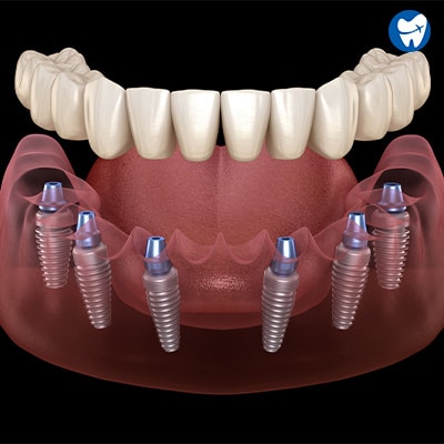 All-on-6-dental-implant-in-lower-jaw