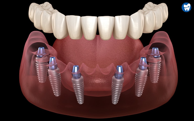 All on 6 dental implants