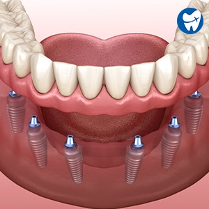 All on 6 dental implants