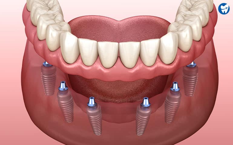 All-on-6 Dental Implant