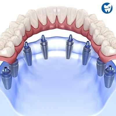 All on 8 dental implants