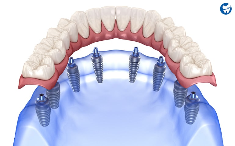All on 8 dental implants