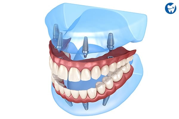 All on 4 dental implants