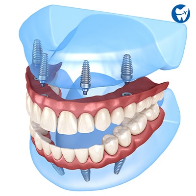 All-on-4 Dental Implants in Medellin, Colombia