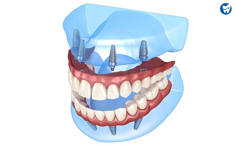 All on 4 Dental Implants in Cambodia