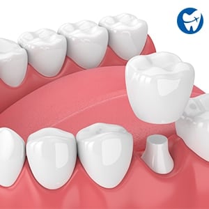 Dental Crowns in Bangkok