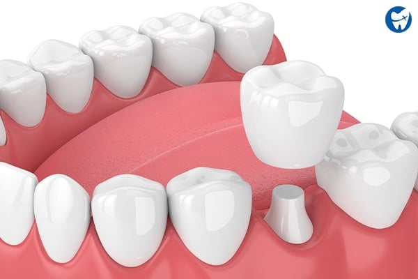 Ceramic Crowns