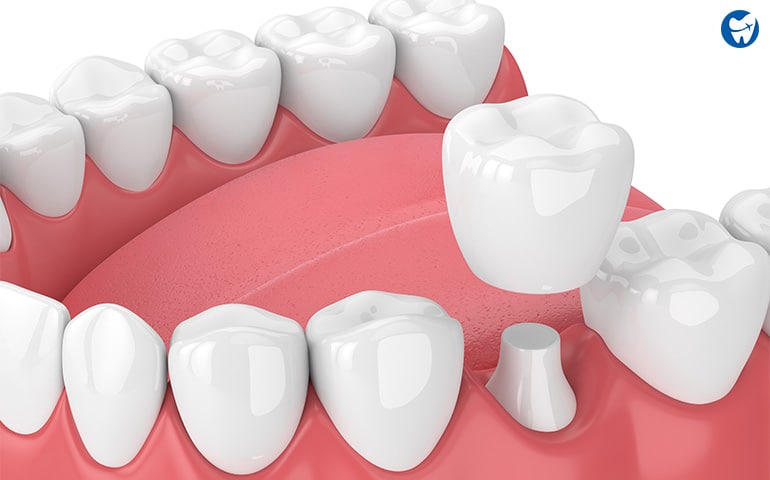 High-Quality Dental Crowns in Puerto Rico