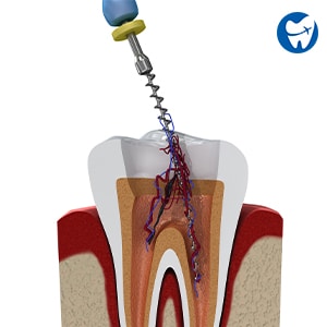 Root Canal in Barranquilla