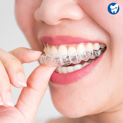 Clear Aligners in Puerto Rico