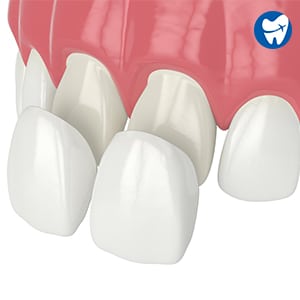 Teeth Veneers
