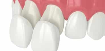 Zirconia Veneer