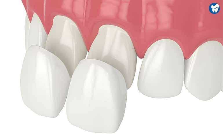 Cosmetic Dental Work in Algodones | Dental Veneers