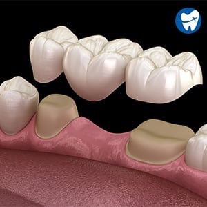 Dental Bridge