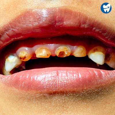 Dental caries in front teeth