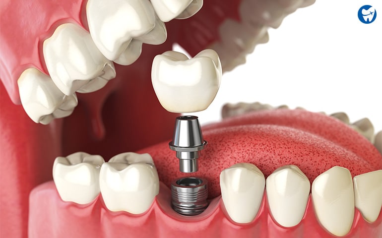 Dental Implants | Alternatives to Dentures