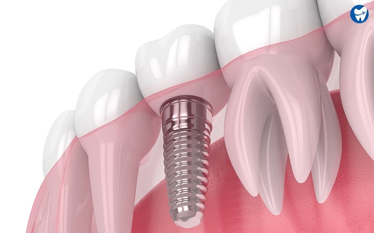 Single Tooth Implant