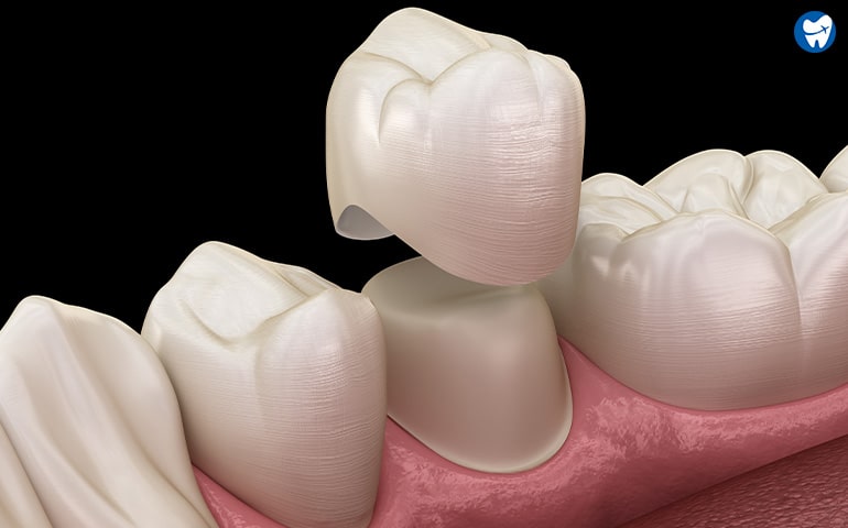 Computerized Dental Crowns in Mexico