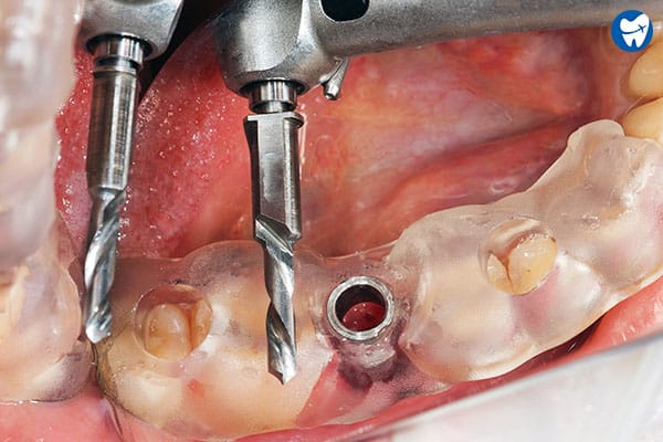 Implant surgery | Dental implants in Cartagena