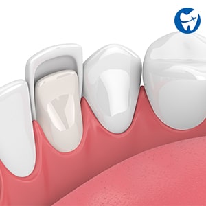 Dental Veneers | Alternative to Dental Crown