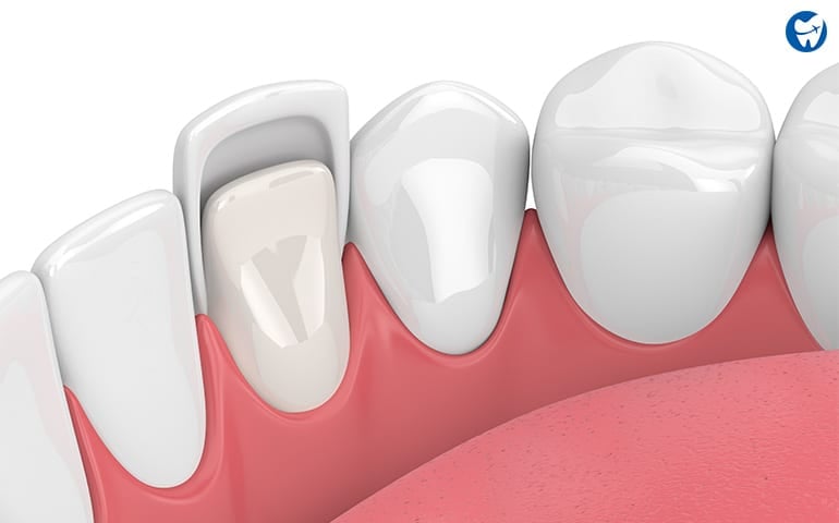 Bonding of Dental Veneers