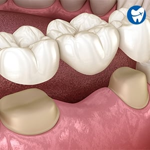 Dental Bridge