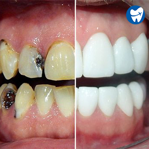 Full mouth restoration – Before & After