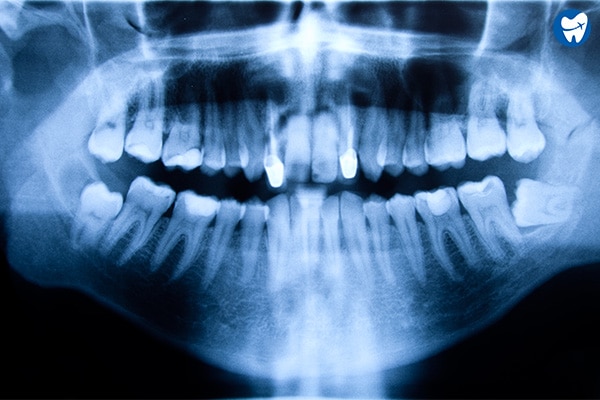Full Mouth X-ray