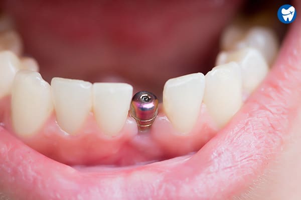 Healed gum | Dental implants in Cartagena
