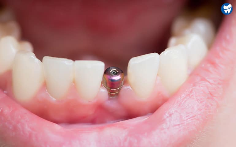 Dental Implant in Romania