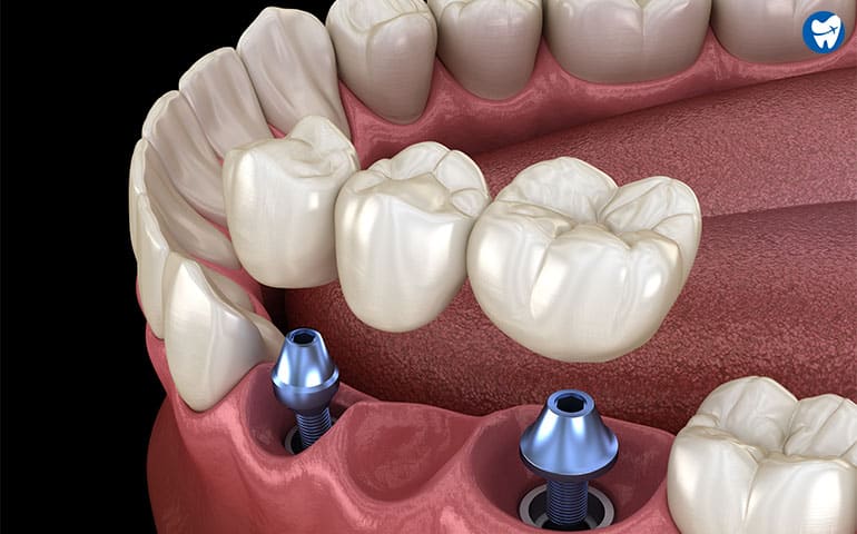 Implant Supported Bridge