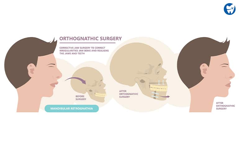 Orthognathic Surgery Illustration