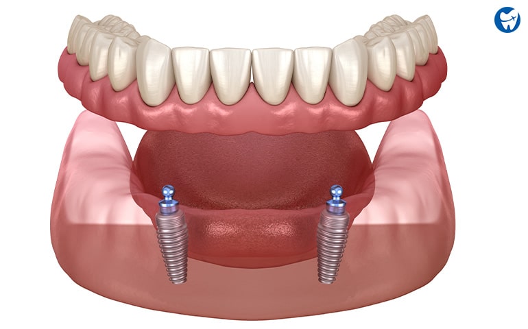 Overdenture