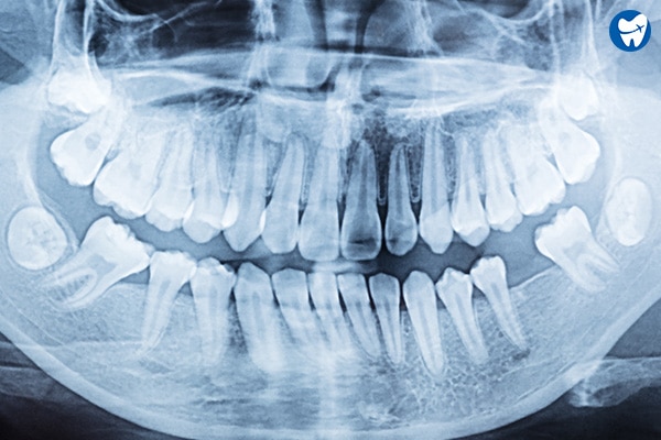 Full mouth x ray