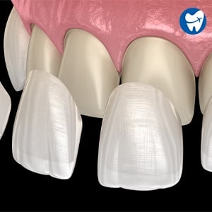 Dental Veneers in Brazil