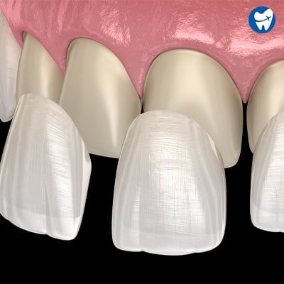 Porcelain veneers