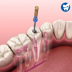 Root canal treatment in Jaco, Costa Rica