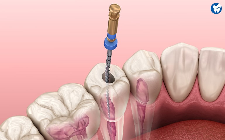 Root Canal Treatment in Cambodia