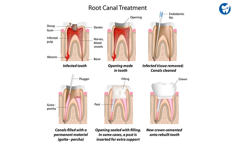Root canal treatment procedure