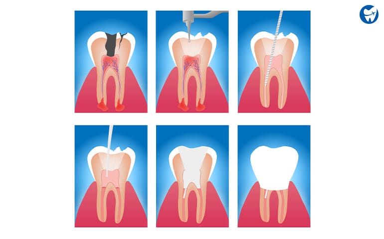 Root-canal