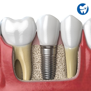 Dental Implants | Monterrey